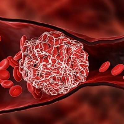 Thrombose/Embolie/CTEPH und Sport